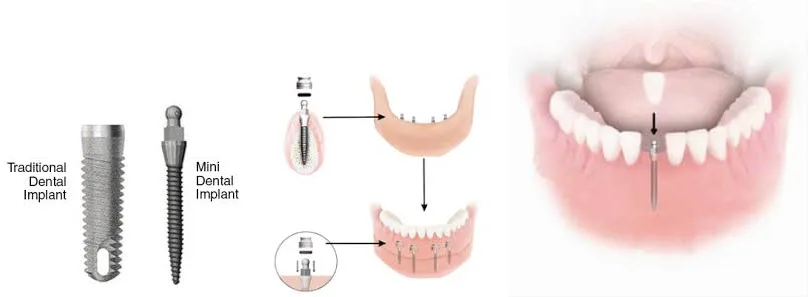 mini implant denture